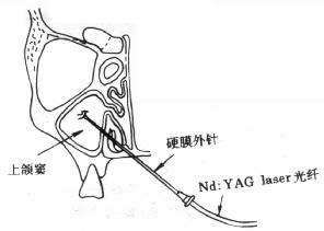 Nd：YAG laser穿刺术