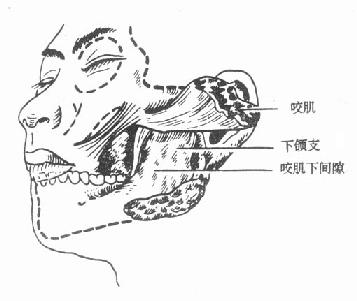 咬肌下蜂窝织发生的部位