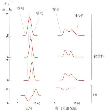 贲门失弛缓症患者测压结果示意图