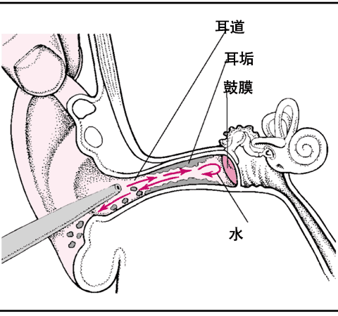 耳道冲洗