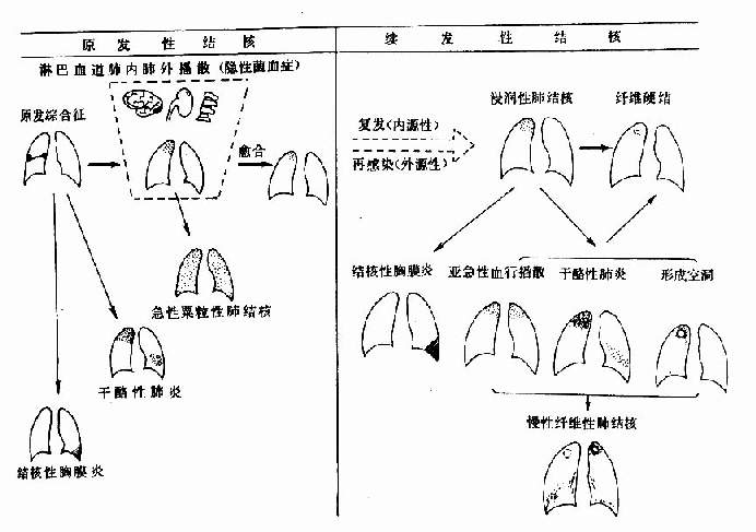 肺结核病自然过程示意图 