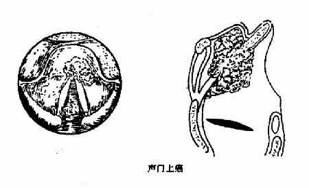 喉癌类型