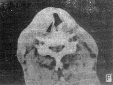 鼻窦、鼻咽和喉部CT扫描