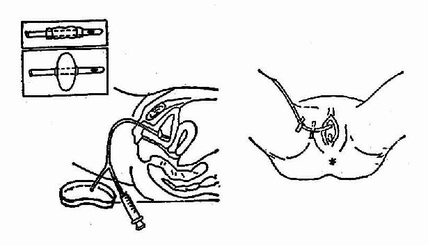 带气囊导尿管留置法