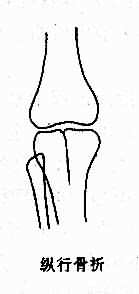 各型骨折示意图-纵行骨折
