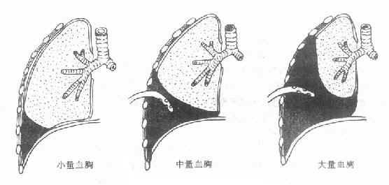 血胸示意图