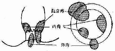 痔的类型与齿状线的关系