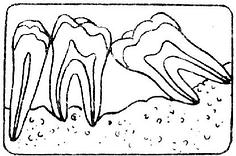 四、单纯性牙周炎（Simple Periodontitis）