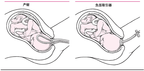 产钳和负压吸引术