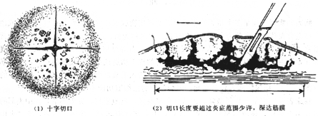 痈的切开引流