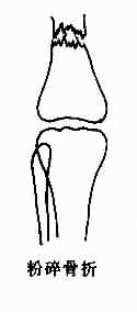 各型骨折示意图-粉碎骨折