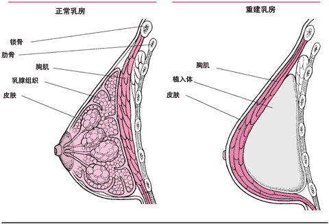 乳房重建