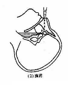 鼻窦置换法