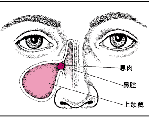 鼻息肉