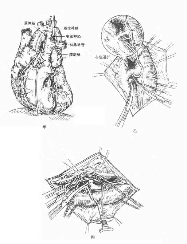 导管处理方法