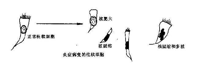 炎症病变的脱落上皮细胸形态改变示意图