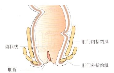 肛裂