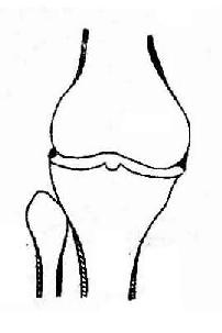 膝关节退行性骨关节病示骨关节面边缘性骨赘