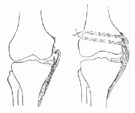 内侧副韧带完全断裂与手术修复示意图