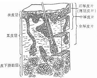 皮肤组织与皮片分类示意图