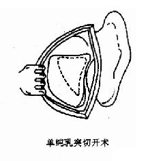 乳突手术类型