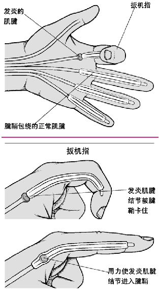 扳机指