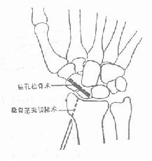 陈旧性舟骨骨折的手术治疗