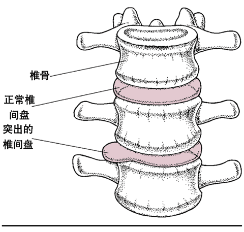 椎间盘突出