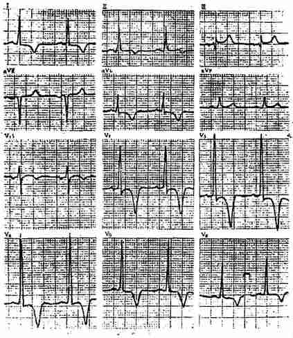 慢性冠状动脉供血不足心电图