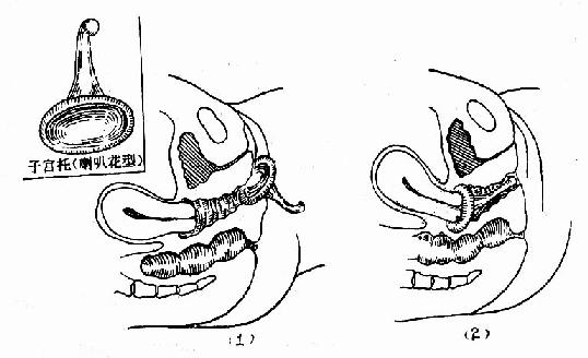 子宫托及其放置
