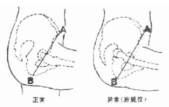 Nelaton线