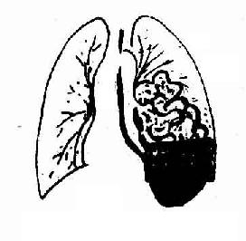 左膈疝小肠疝入胸腔