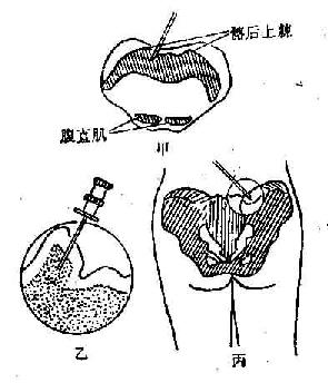 髂后上棘穿刺术