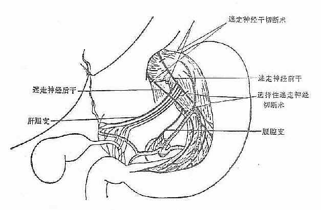 迷走神经切断手术示意图