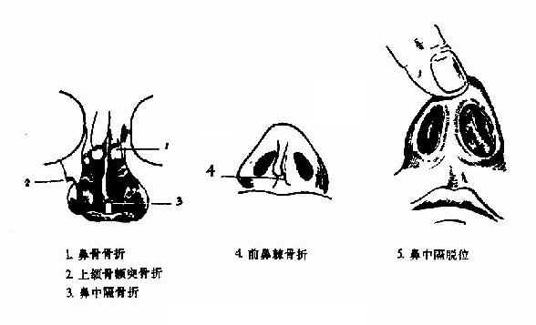 鼻骨骨折及鼻中隔脱位