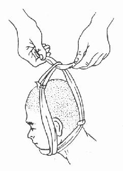 四尾带包扎法