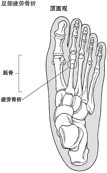 足部疲劳性骨折