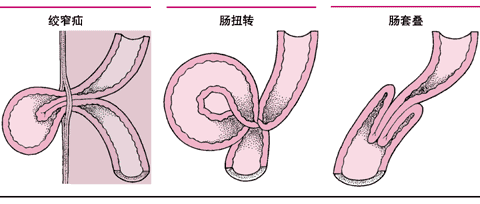 引起肠绞窄的情况