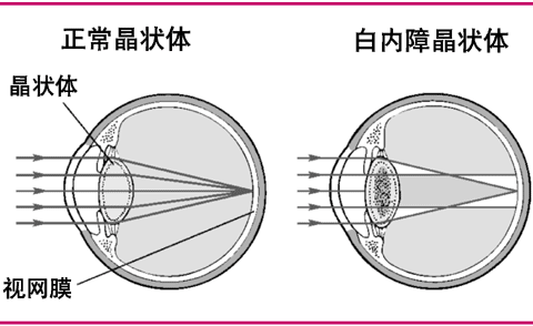 白内障如何影响视力