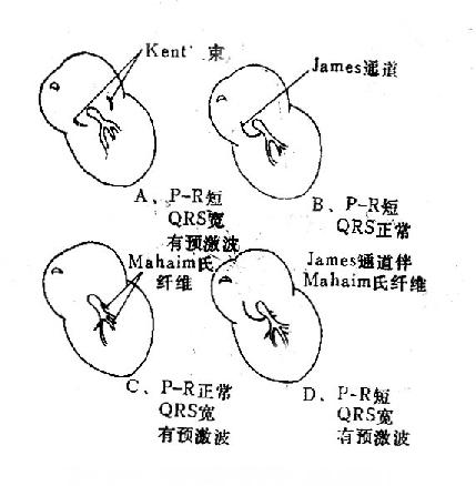 预激症候群示意图