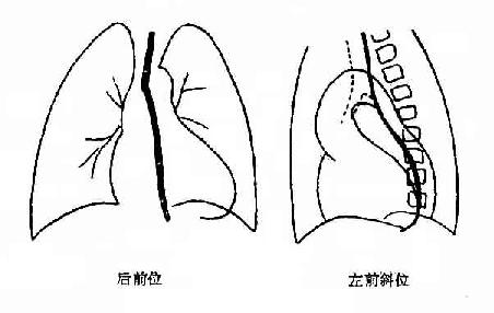 主动脉瓣关闭不全