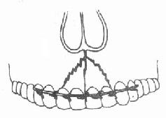 牙槽突骨折和牙弓夹板结扎固定
