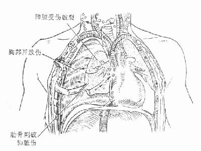 气体进入胸腔和纵隔的途径